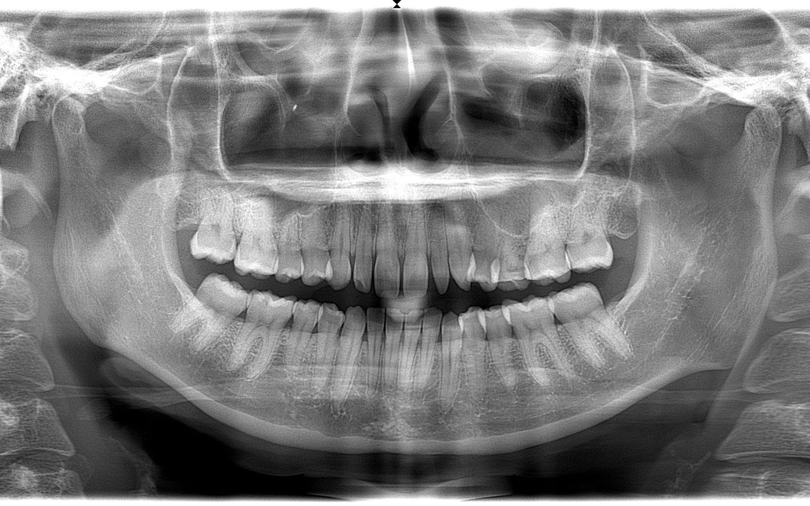 Peg Lateral in X-Ray Scan